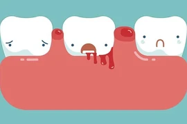 Giải pháp cải thiện chảy máu chân răng hay tái phát từ sản phẩm thiên nhiên