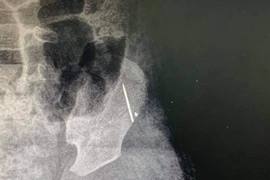 Kim khâu nằm sát xương cánh chậu