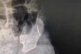 Kim khâu nằm sát xương cánh chậu