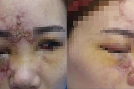 14 tuổi mù hai mắt và hoại tử mũi vì tiêm filler
