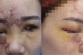 14 tuổi mù hai mắt và hoại tử mũi vì tiêm filler