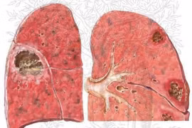 Áp xe phổi dễ vỡ và tử vong