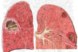 Áp xe phổi dễ vỡ và tử vong