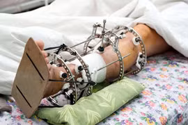 Nga phát triển thành công xương nhân tạo