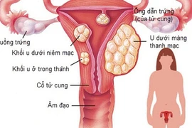 Suy gan cấp do uống thuốc Nam cho teo u xơ tử cung