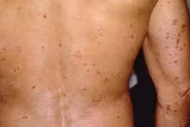 Nguyên nhân gây bệnh ngoài da