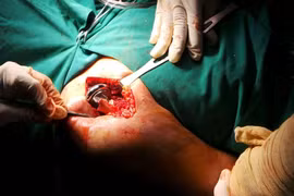 Chỉ định thay khớp vai khi đau 