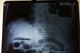 Cứu bệnh nhân tắc ruột và thoát vị hoành