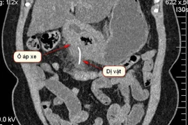 Nuốt tọt xương cá dài 5cm, người phụ nữ chỉ chậm chút nữa thì có thể tử vong