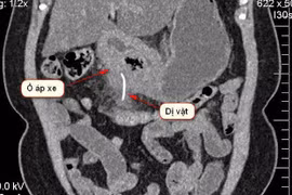 Nuốt tọt xương cá dài 5cm, người phụ nữ chỉ chậm chút nữa thì có thể tử vong