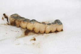 Cả hàm răng rơi vào phế quản