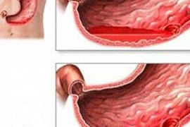 Cảnh báo chảy máu dạ dày bởi món ăn vặt phổ biến mùa lạnh