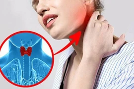 Bí quyết cải thiện bệnh cường giáp an toàn, hiệu quả từ sản phẩm thảo dược 