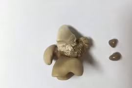 Mất thận vì 30 năm không điều trị sỏi