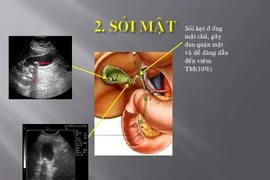 Phát hiện sớm sỏi túi mật tránh các biến chứng nguy hiểm tính mạng