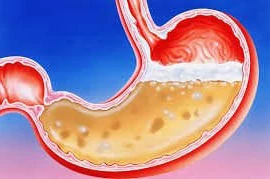 Rượu bia ảnh hưởng dạ dày như thế nào?