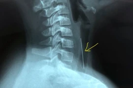 Bé 10 tuổi thủng khí quản vì nuốt nhầm cây kim