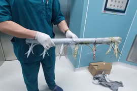 Bất cẩn ngã từ lầu hai, hàng rào sắt đâm thấu bụng