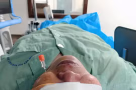 Tiêm cồn diệt hạch Gasser trị đau nửa mặt