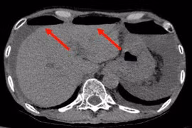 Cứu bệnh nhân sốc nhiễm trùng do thủng ruột