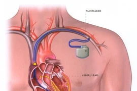 Suy tim độ 4 do hẹp hở van tim 
