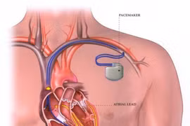 Suy tim độ 4 do hẹp hở van tim 