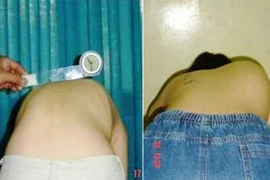 Điều trị vẹo cột sống tự phát