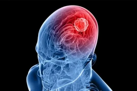 Ảnh minh họa ung thư não