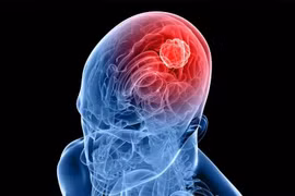 Ảnh minh họa ung thư não
