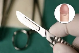 Hẹp bao quy đầu khi nào cần cắt?