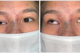 Cô gái 17 tuổi tắc hoàn toàn động mạch mắt phải sau tiêm filler tại Spa