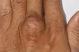 Đột biến gene lạ xuất hiện liên tiếp ở nhiều người trong cùng gia đình