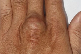 Đột biến gene lạ xuất hiện liên tiếp ở nhiều người trong cùng gia đình