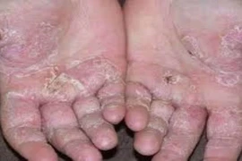 Tổ đỉa có tái phát?