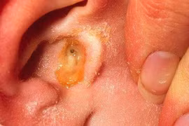  Liên tục viêm tai do dùng kháng sinh dự phòng