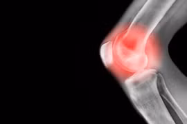 Biểu hiện của u xương sụn