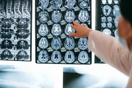 AI Việt chẩn đoán bệnh Alzheimer trong 10 phút
