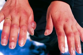 Bỏng lạnh cực nguy hiểm nếu không được sơ cứu đúng cách nhưng mọi người vẫn chưa nâng cao cảnh giác