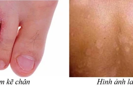 Cẩn thận với bệnh nấm chân trời nồm