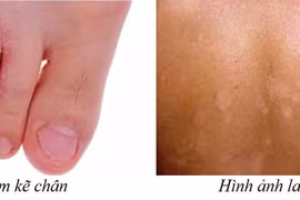 Cẩn thận với bệnh nấm chân trời nồm