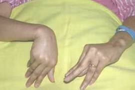 Tổn thương tuyến cận giáp 