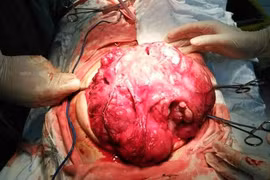 U quái ở trẻ nhỏ thường ác tính