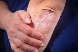 Bệnh vảy nến toàn thân và cách cải thiện hiệu quả