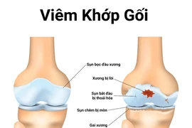 Ai dễ mắc viêm khớp gối? 
