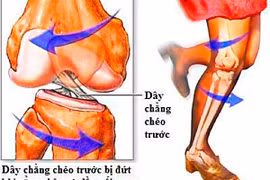  Đứt dây chằng chéo trước