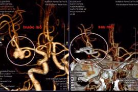 Hình ảnh sau mổ cho thấy đã kẹp hoàn toàn cổ của túi phình, ngăn chặn dòng máu vào túi phình hiệu quả.