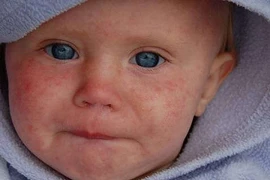 Cách phát hiện sởi từ khi chưa phát ban