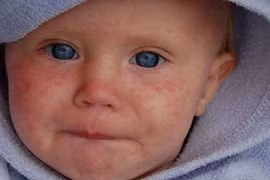 Cách phát hiện sởi từ khi chưa phát ban