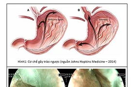 Ba biến chứng của trào ngược thực quản
