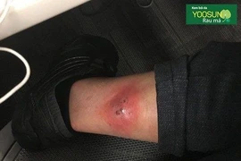 Da hoại tử vì nhện cắn